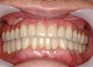 症例2 : 上顎無菌顎・下顎部分欠損症例