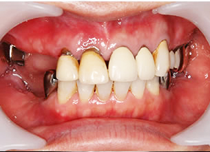 症例3 : 上下顎部分欠損症例