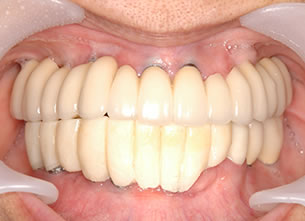 症例1 : 仮骨延長法