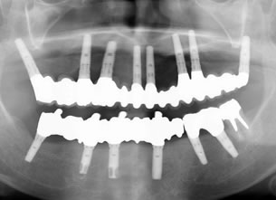 症例1 : 仮骨延長法