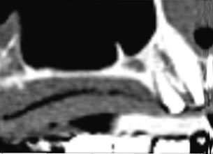 症例3 : サイナスリフト