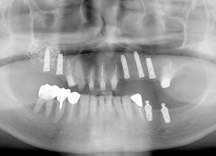症例3 : サイナスリフト