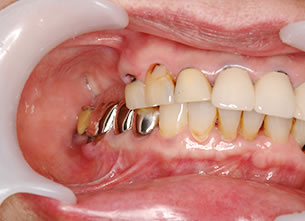 症例3 : サイナスリフト